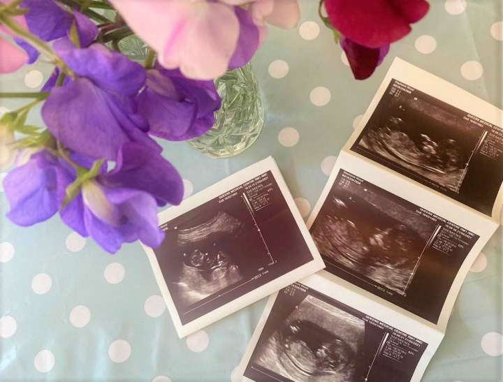 Twins – The First&nbsp;Trimester